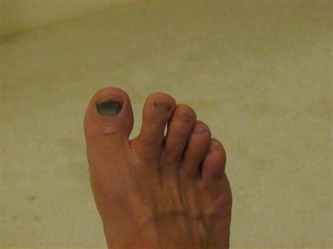 Bruise Under the Big Toenail Treatment: *Secrets Shared by a Podiatrist!*