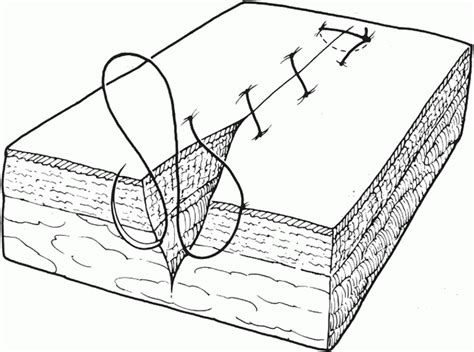 Image result for Continuous Suture Patterns