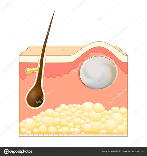 Wen Sebaceous Cyst Form Trichilemmal Cyst Epidermoid Pilar Cysts Cross Stock Vector by ...