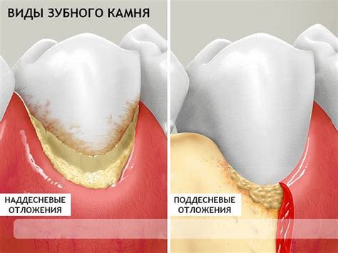 Что такое зубной камень. Как удаляют зубной камень