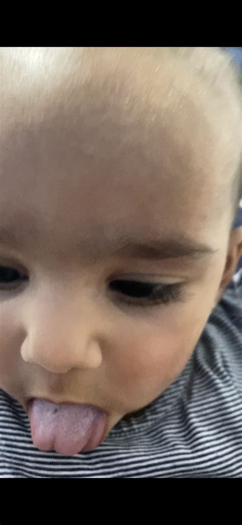 What Is Black Dots On Tongue - Infoupdate.org