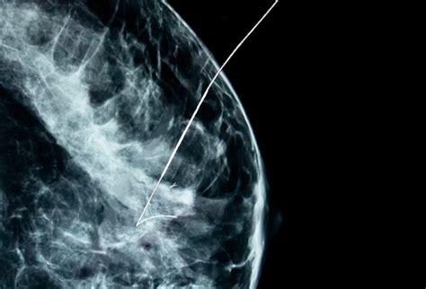 Wire Localization Procedure 的图像结果