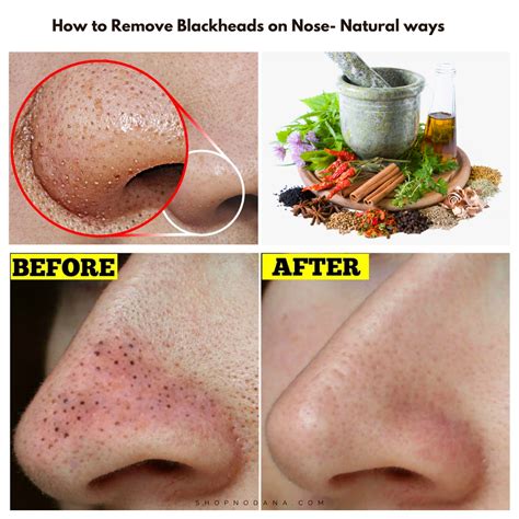 Remove Blackheads Naturally From Nose at Bobby Gibson blog