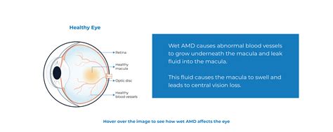 WAMD - Wet Age Related Macular Degeneration - Kodiak Sciences