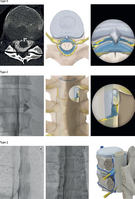 Cerebrospinal Fluid Leak Spine