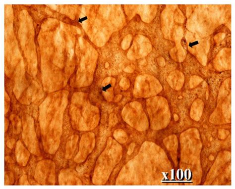 The Development of Peritoneal Metastasis from Gastric Cancer and ...