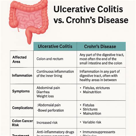 Ulcerative Colitis vs. Crohn’s Disease: Know the Difference