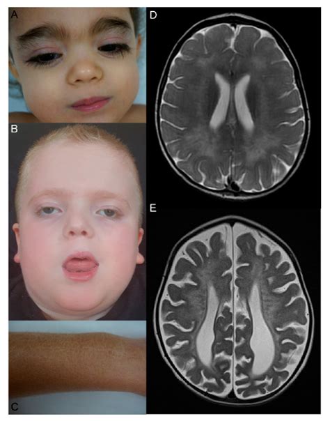 Multiple Sulfatase Deficiency: A Disease Comprising ...