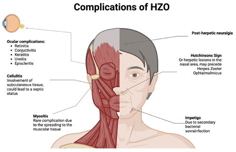 Orbital Myositis after Herpes Zoster Ophthalmicus: A Case Report and a ...