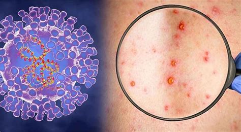 भारत में भी डराने लगा मंकीपॉक्स वायरस! यूपी के सभी अस्पतालों में अलर्ट ...