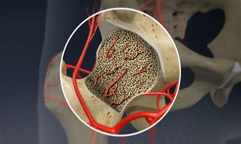 Explained: What is Avascular Necrosis, the latest post-COVID condition