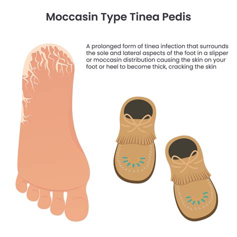 Moccasin type tinea pedis athlete's food education vector infographic ...