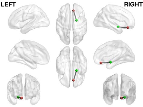 Image result for Depression Amygdala Prefrontal Cortex