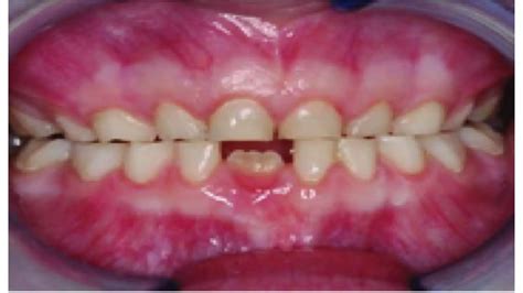 ATTRITION OF TEETH (Regressive Alterations of Teeth) | PPTX