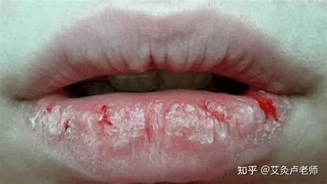 【上嘴唇肿了】【图】上嘴唇肿了怎么办 告诉你嘴唇红肿的3个原因_伊秀健康|yxlady.com