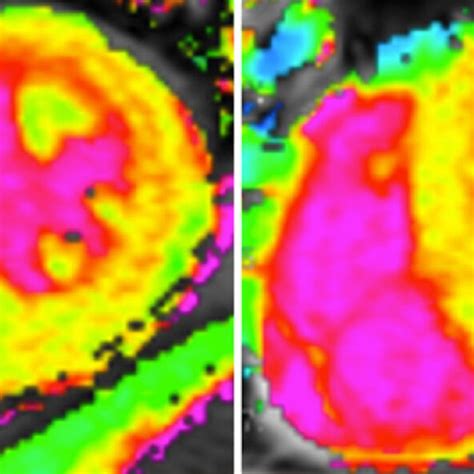 Tafamidis zur Behandlung der Transthyretin-Amyloid-Kardiomyopathie ...
