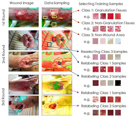 Granulation Tissue Wound Healing