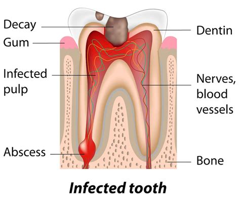 Image result for Abscessed Tooth Explosion