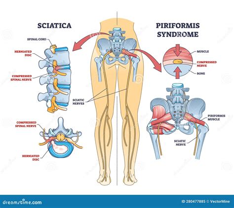Piriformis Syndrome Vs Sciatica
