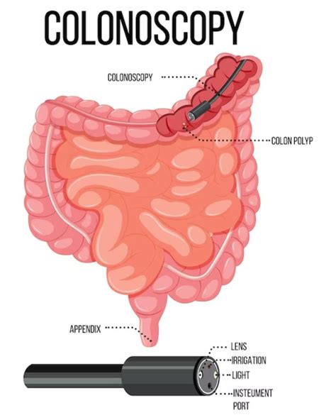Colonoscopy Process 的图像结果