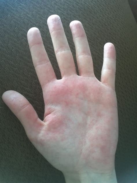 shingles on palms of hands - pictures, photos