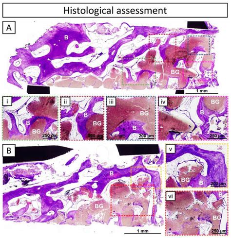 Three-Dimensional Printed Patient-Specific Vestibular Augmentation: A ...