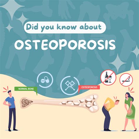 Know About Osteoporosis Dr Akram Jawed | Dr Akram Jawed's The Upper ...
