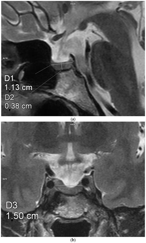 The Influence of Pituitary Morphology on the Occurrence of Hormonal ...