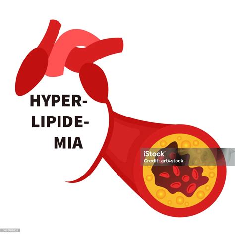 Hyperlipidemia Conceptual Illustration Stock Illustration - Download ...