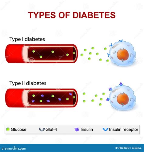 Tipos de diabetes ilustración del vector. Ilustración de aumentado - 70624036