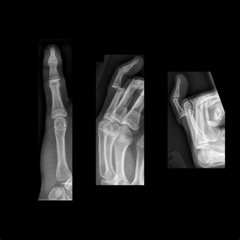 Pediatric Phalanx Fracture in the Hand | Pediatric Radiology Reference Article | Pediatric ...