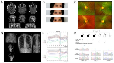 Expanding the Phenotype of the FAM149B1-Related Ciliopathy and ...