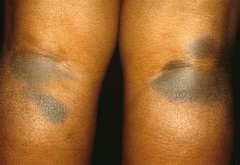 Weird Dark Patches On Skin at Edwin Whitlow blog