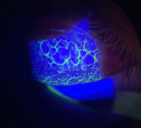 Giant Papillary Conjunctivitis (gpc)