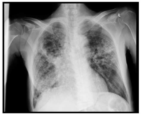 The Use of COVID-19 Surveillance Measures in Detecting Cases of ...
