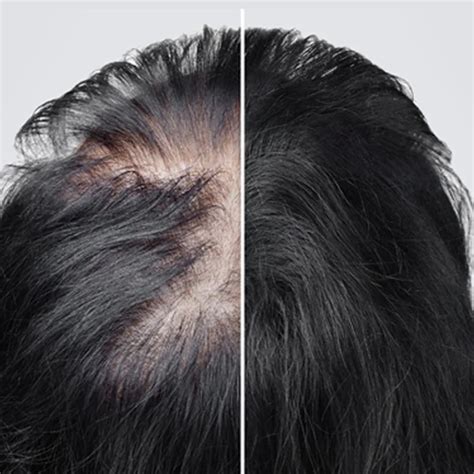 Female Hair Transplant- Permanent Solution for Female Hair Loss: DNCC