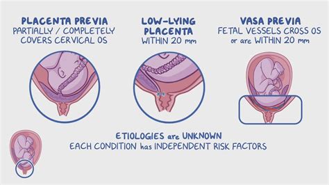 Placenta previa and vasa previa: Video & Meaning | Osmosis