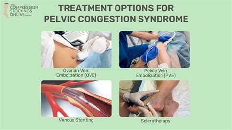 What is Pelvic Congestion Syndrome? Causes & Treatment – Compression ...