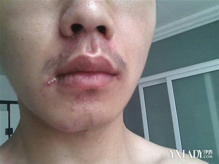 【图】鼻子嘴巴周围长痘痘是怎么回事 3种原因告诉大家_伊秀美容网|yxlady.com