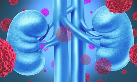 Even low levels of arsenic in drinking water raise kidney cancer risk ...