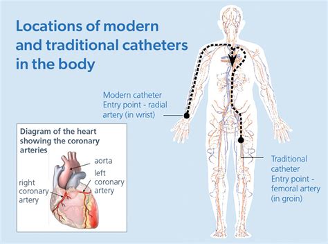 Coronary angiography - South Tees Hospitals NHS Foundation Trust