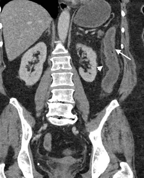 Ischaemic colitis: practical challenges and evidence-based ...