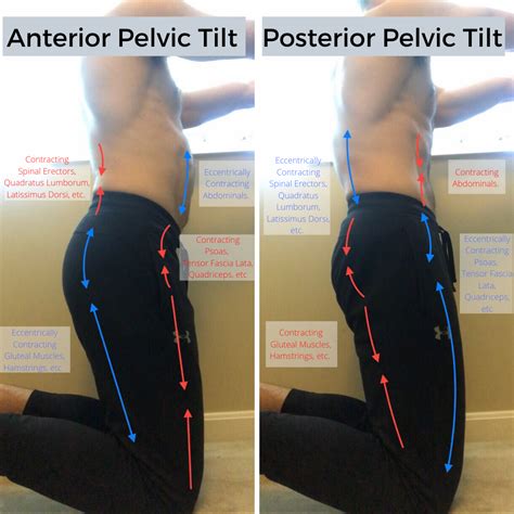 Anterior Pelvic Tilt Anterior Pelvic Tilt How To Fix Your