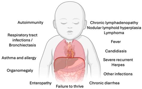 Inflammatory Bowel Disease in Activated PI3Kδ Syndrome: An Uncommon ...