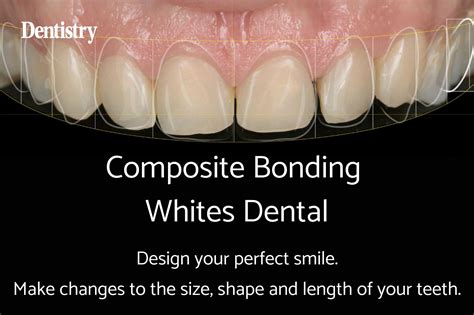 composite_bonding - Dentistry.co.uk