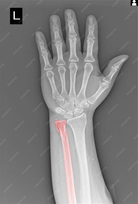 Premium Photo | Film x-ray hand fracture ulna.