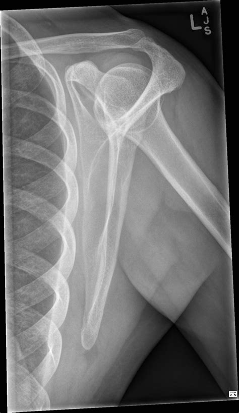 Normal Shoulder X Ray Labeled at Lindsay Johnson blog