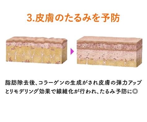 【SNSでも話題！】従来の1万倍配合の脂肪溶解注射「FatX Core」が松戸院で取扱開始 - 松戸院