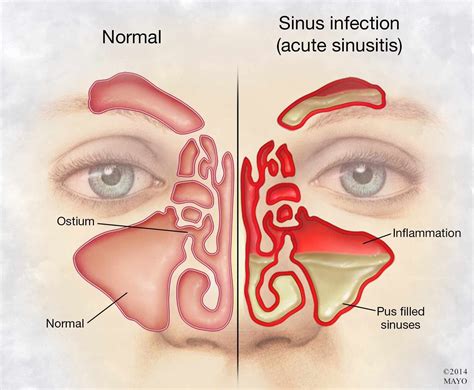 Maxillary sinus – Artofit