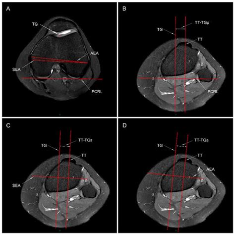 Tibial Tubercle to Trochlear Groove Distance Measured by Posterior ...